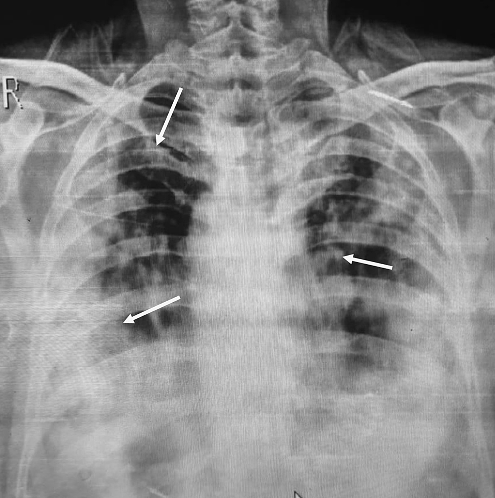 Pcp Pneumonia Chest X Ray