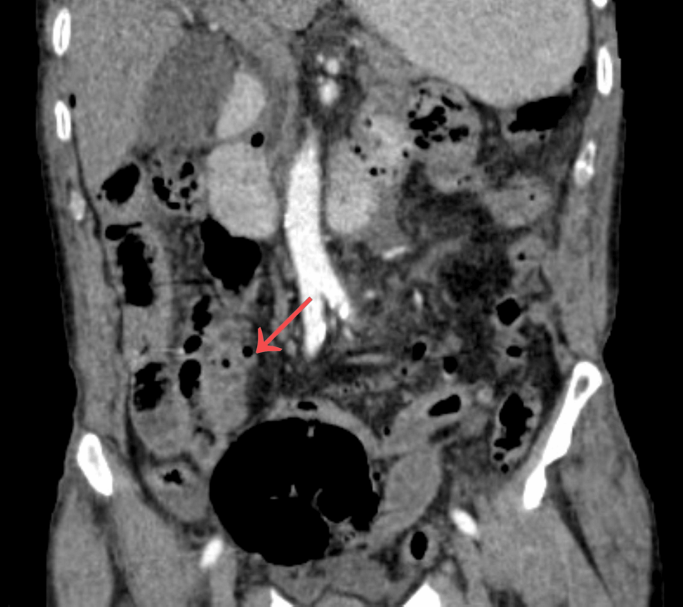 diverticulitis bpc 157 Perforated Ileal Presenting With Acute Peritonitis in an Elderly Patient: A Case Report Servings:60 Servings How to self-inject intramuscular Auto Tag - Recovery