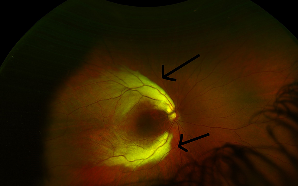 Ocular Findings Associated With Myelinated Retinal Nerve Fibers Cureus