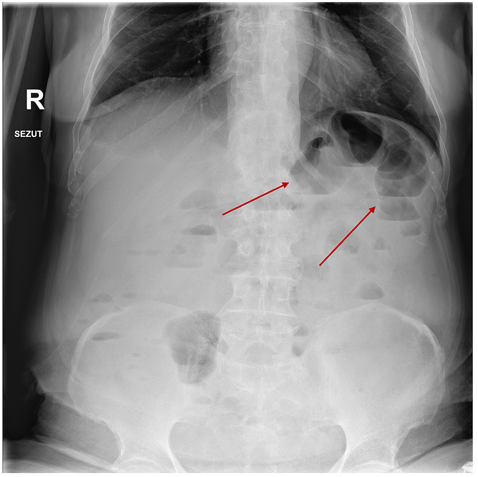 Capecitabine-Induced Terminal Ileitis: Case Report and Literature ...