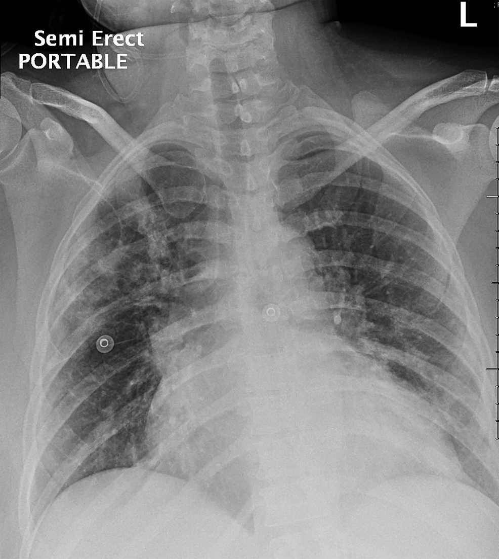 Cureus Persistent Cardiac Resonance Imaging Features of