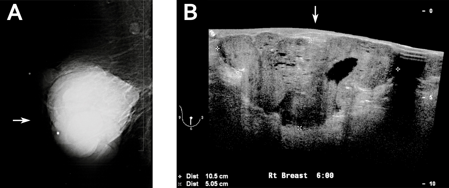 phyllodes-tumor-of-the-breast-ultrasound-pathology-correlation-ajr