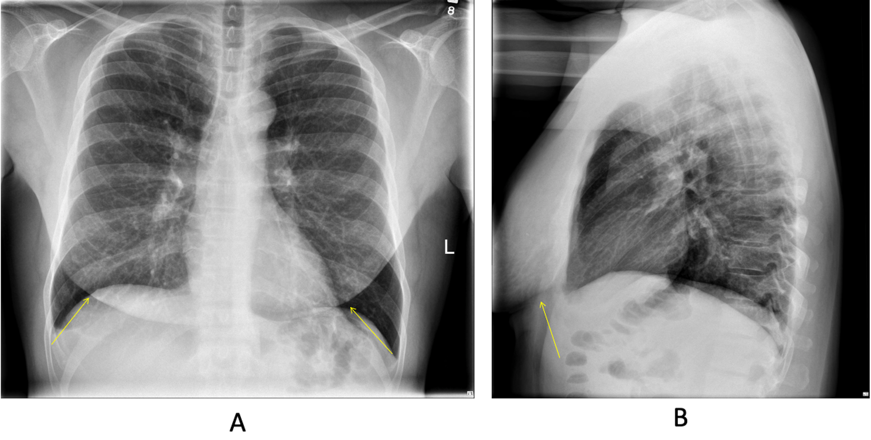 Cureus | Diagnosis and Management of Rare Siliconomas in an HIV Patient