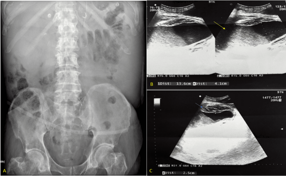 Perforated Necrotizing Cholecystitis, Niemeier Type II, With Subcutaneous Abscess in a Frail Elderly Patient: Challenges in Diagnosis and Management