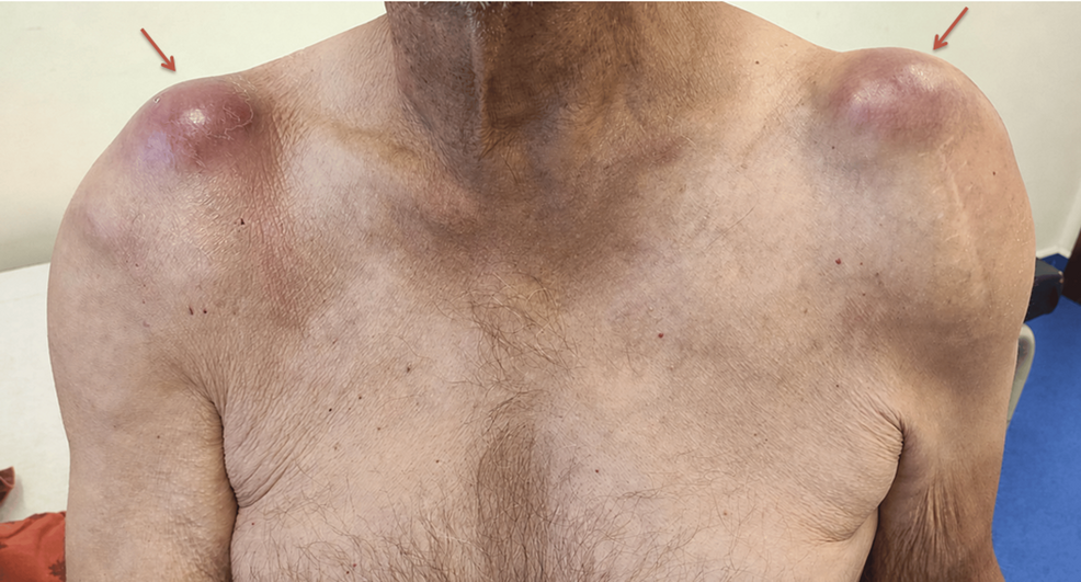 Bilateral Geyser Sign in Calcium Pyrophosphate Deposition Disease