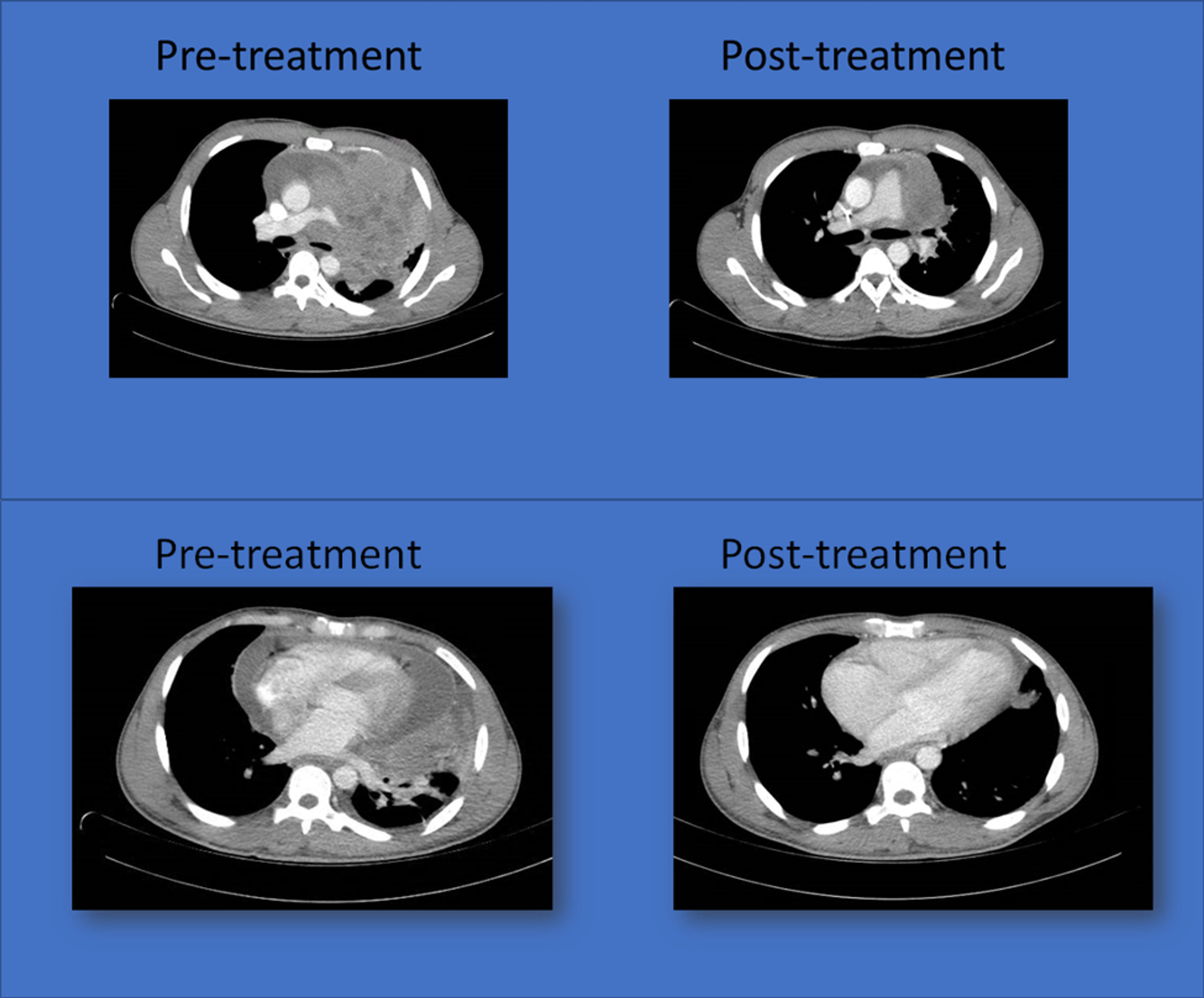 Cureus A Case Of Primary Mediastinal Seminoma Associated With Testicular Microlithiasis And 6986