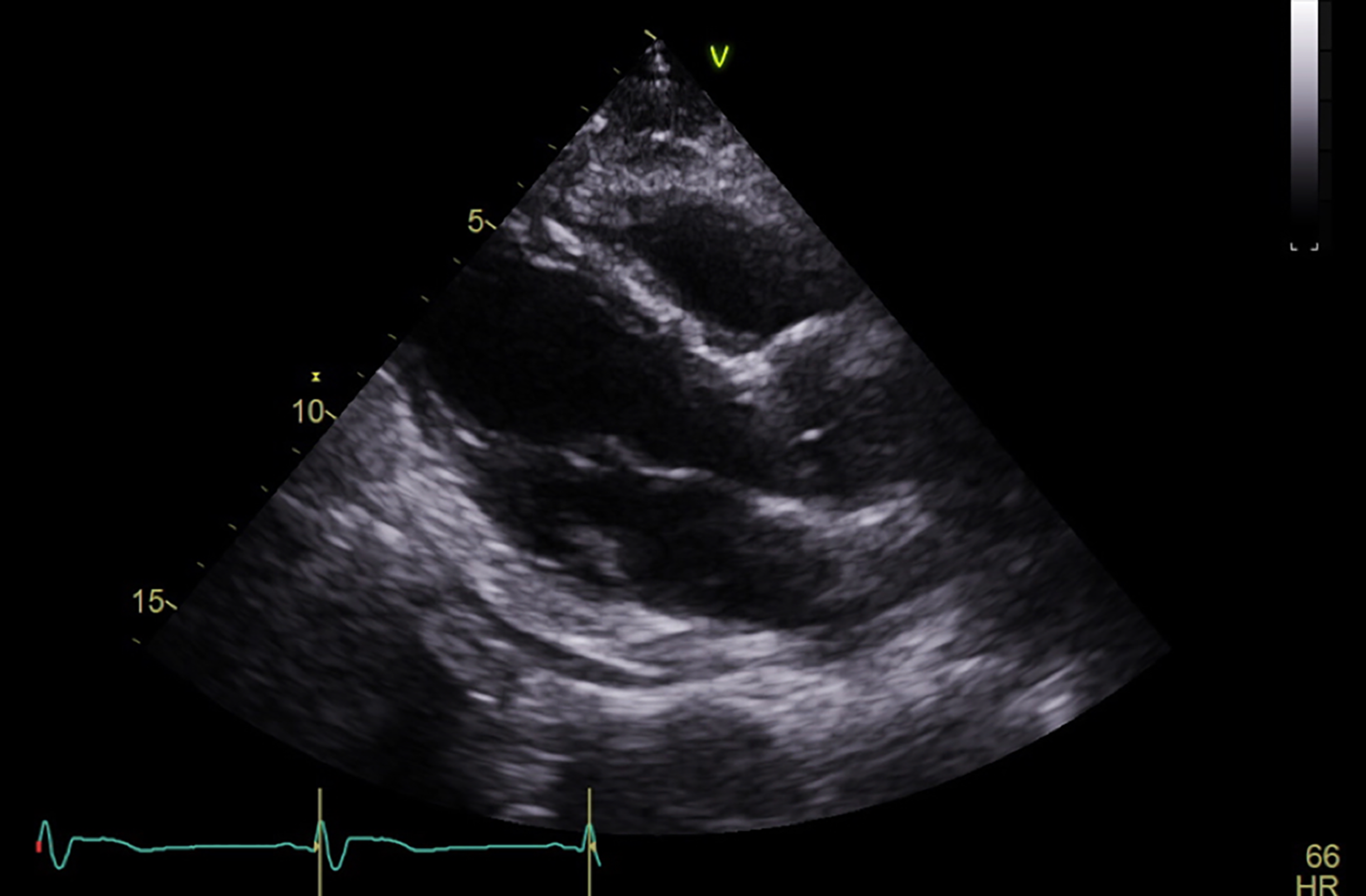 Cureus | A Delayed Case of Pericarditis Following Recovery From COVID ...