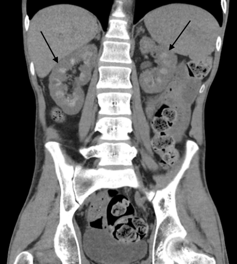 iv glutathione following ct scan Pulmonary Emphysema in a Child With Alpha-1 Antitrypsin Deficiency: Evaluation of 2 Years of Intravenous Augmentation Therapy Frontiers | Intravenous immunoglobulins for