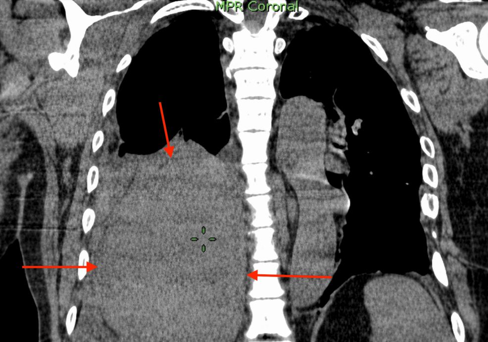 Spontaneous Extrapleural Hematoma: A Rare Cause of Acute Chest Pain in Hemodialysis Patients