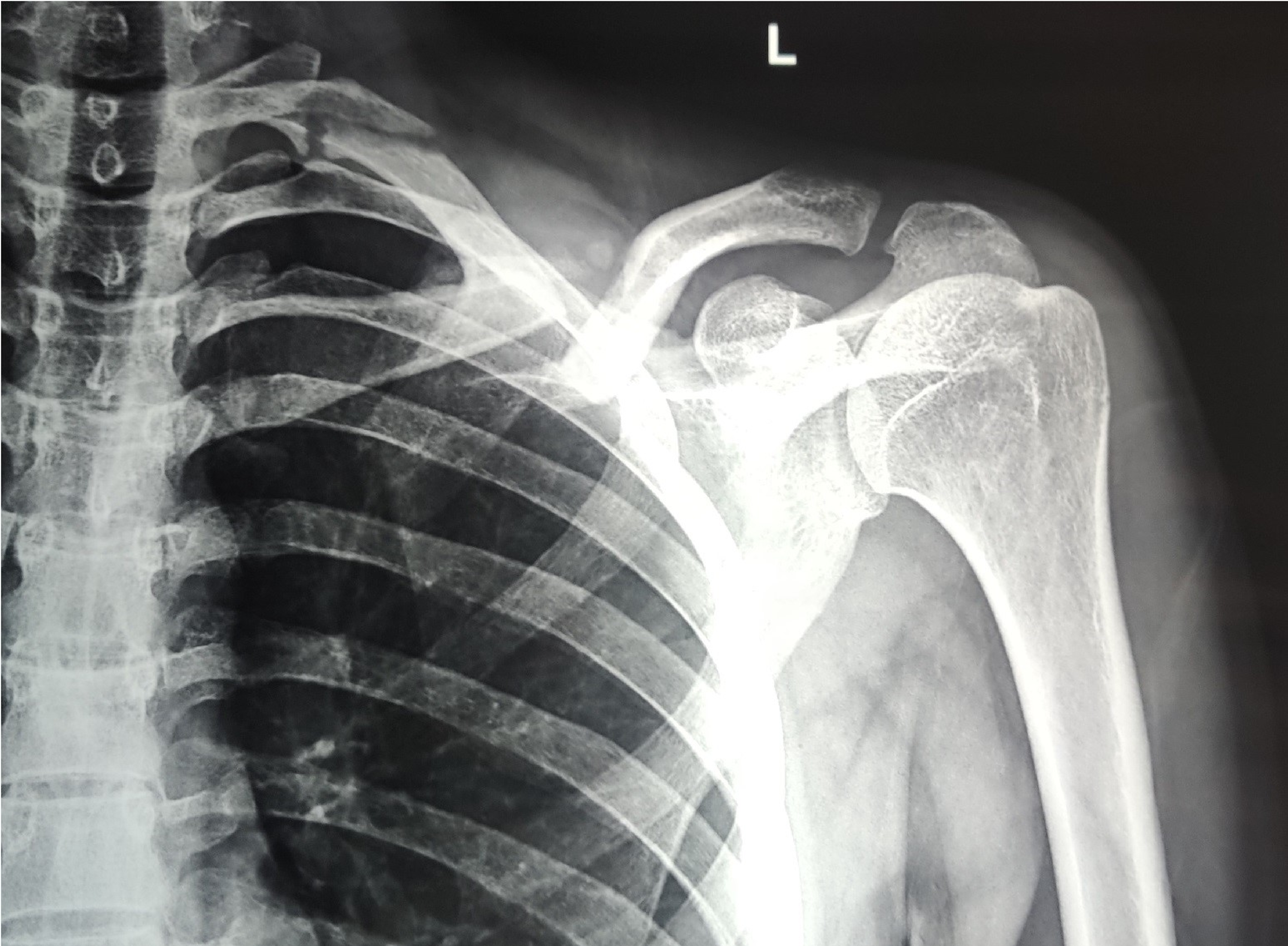 Cureus Plate Osteosynthesis Or Figure Of Eight Brace Which One Is Better In Midshaft Clavicle Fractures