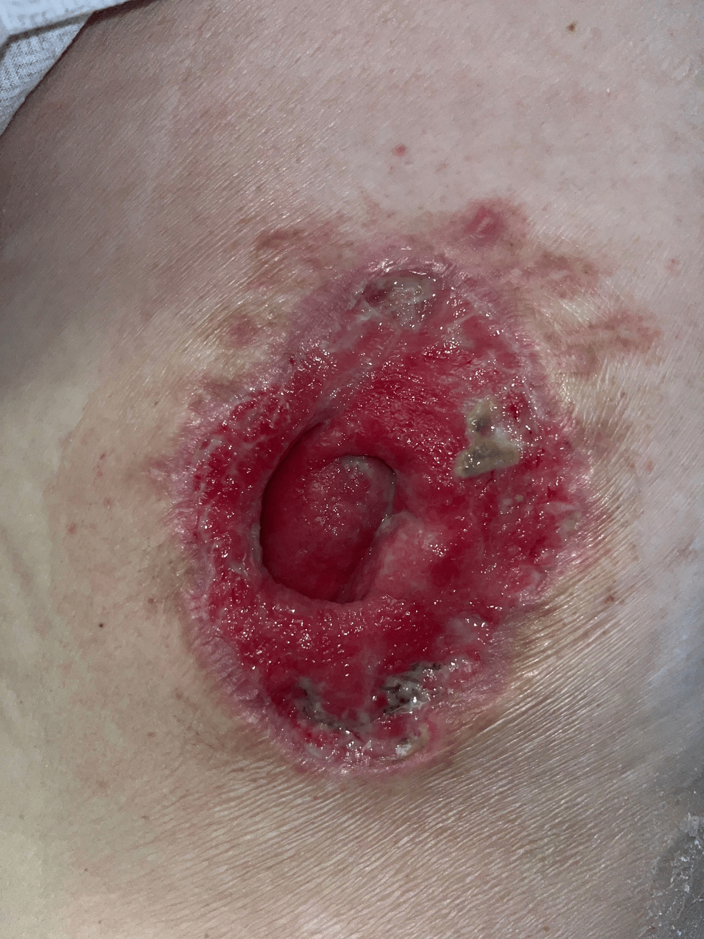 mycobacterium abscessus from b12 injections Injection-Site Abscess Caused by Mycobacterium abscessus Following  Testosterone Injection: A Case Report