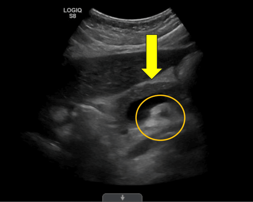 Gallbladder Mucosa-Associated Lymphoid Tissue (MALT) Lymphoma With Gallstone Pancreatitis and Prostate Cancer