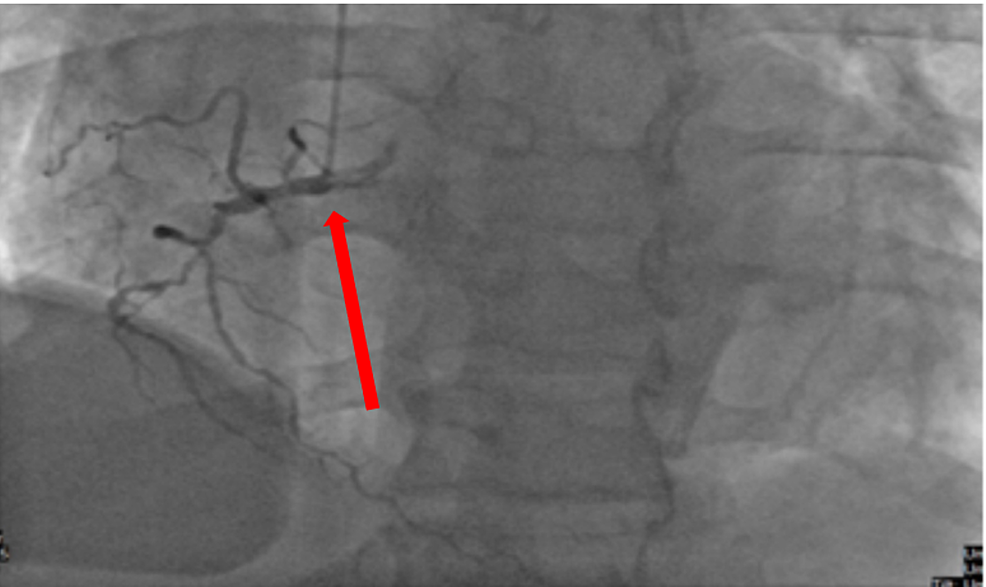 Right-coronary-artery-showed-proximal-chronic-total-occlusion-(red-arrow)