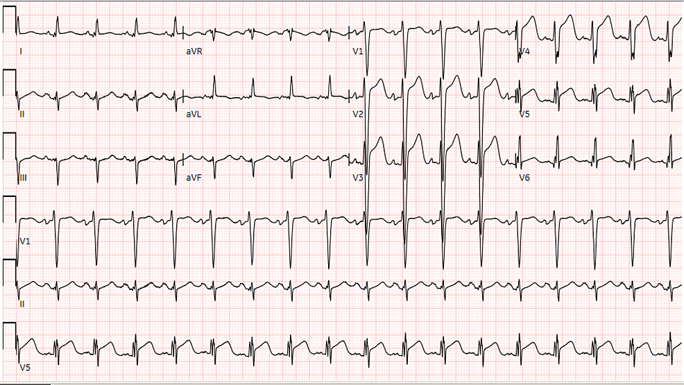 ECG-shows-ST-elevation-in-the-anterolateral-leads-concerning-for-acute-MI/STEMI