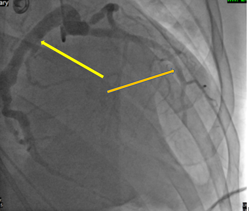 After-percutaneous-angioplasty,-a-stent-was-placed-to-the-left-anterior-descending-artery-(orange-arrow),-patent-circumflex-artery,-and-moderate-diffuse-ectasia-of-the-left-anterior-descending-artery-(yellow-arrow)
