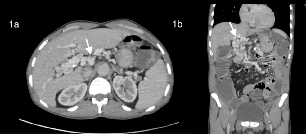 Cavernomatous Transformation of the Portal Vein in Crohn's Disease: An Unexpected ...