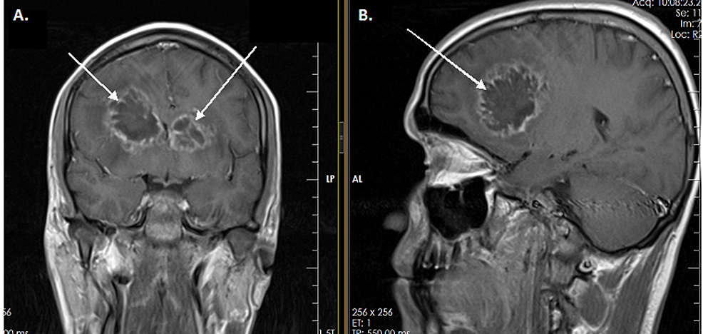 Cureus A Rare Case of Brain Abscesses Caused by Acremonium