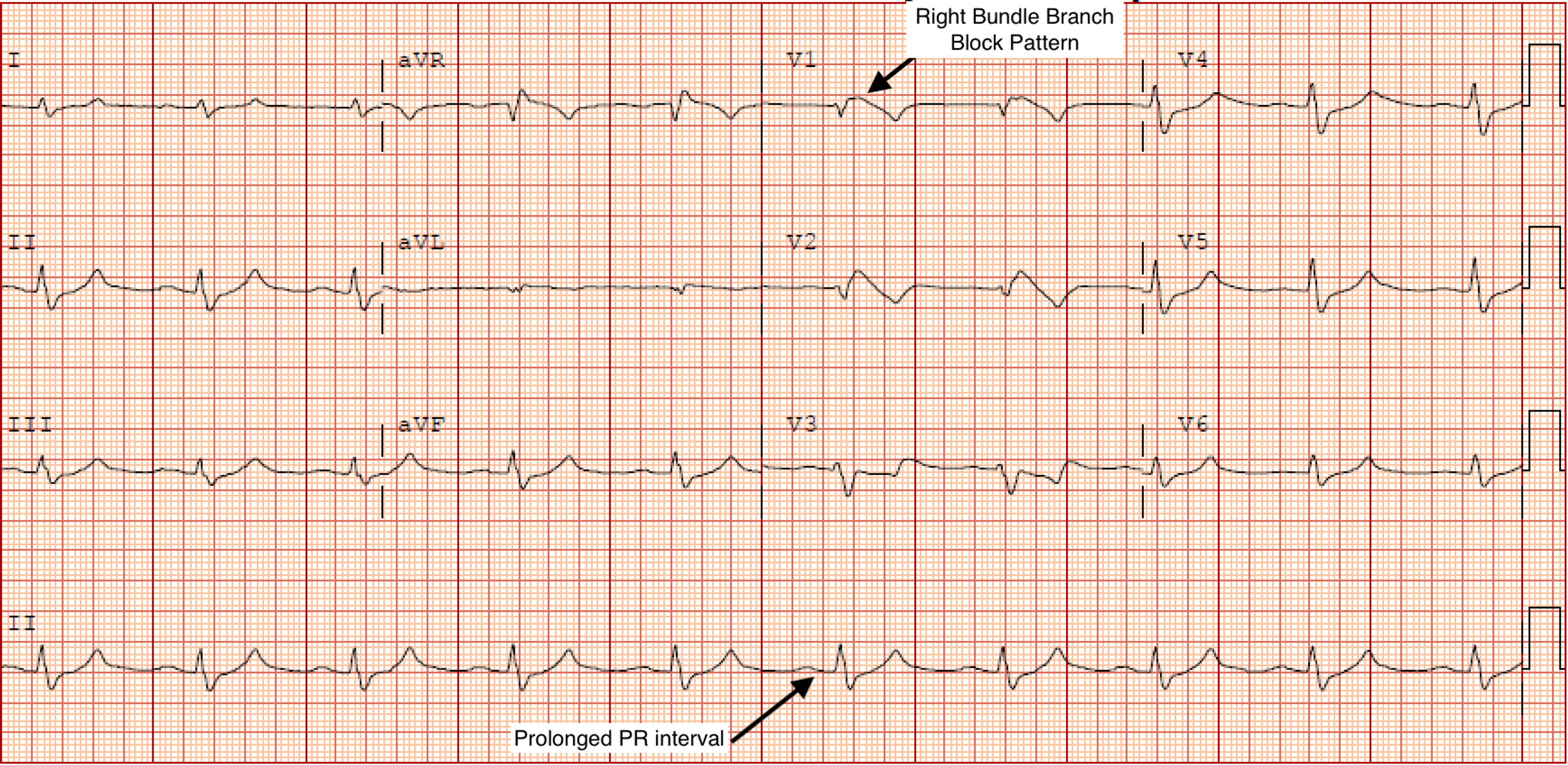 Cureus | A Case of Adrenal Crisis-Induced Stress Cardiomyopathy