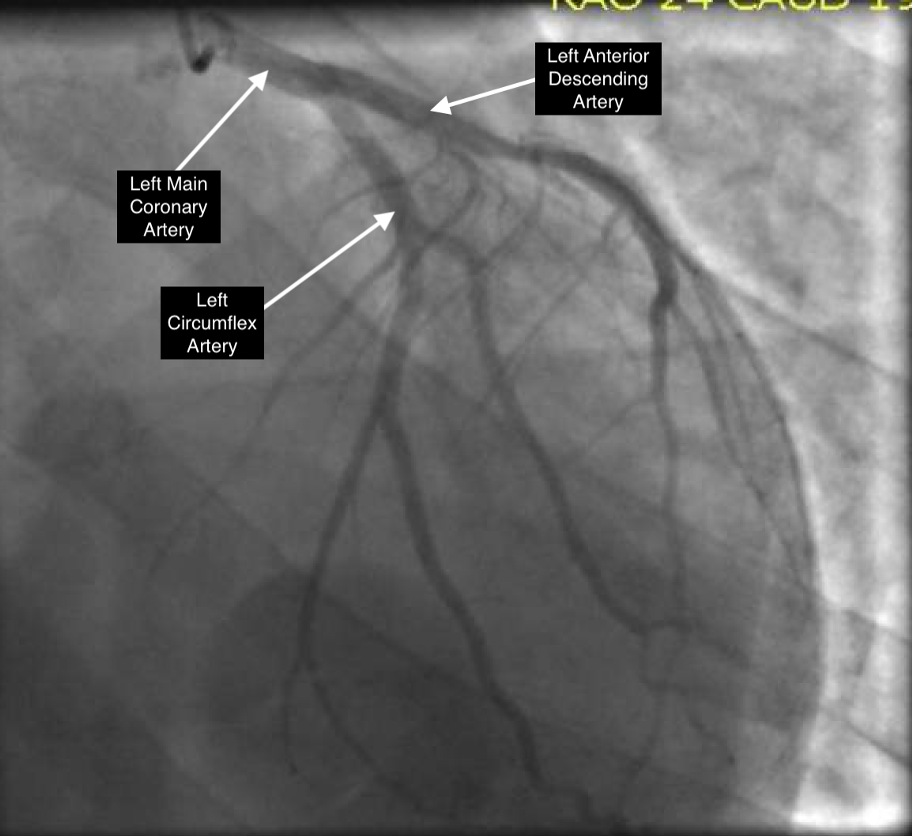 Cureus A Case Of Adrenal Crisis Induced Stress Cardiomyopathy