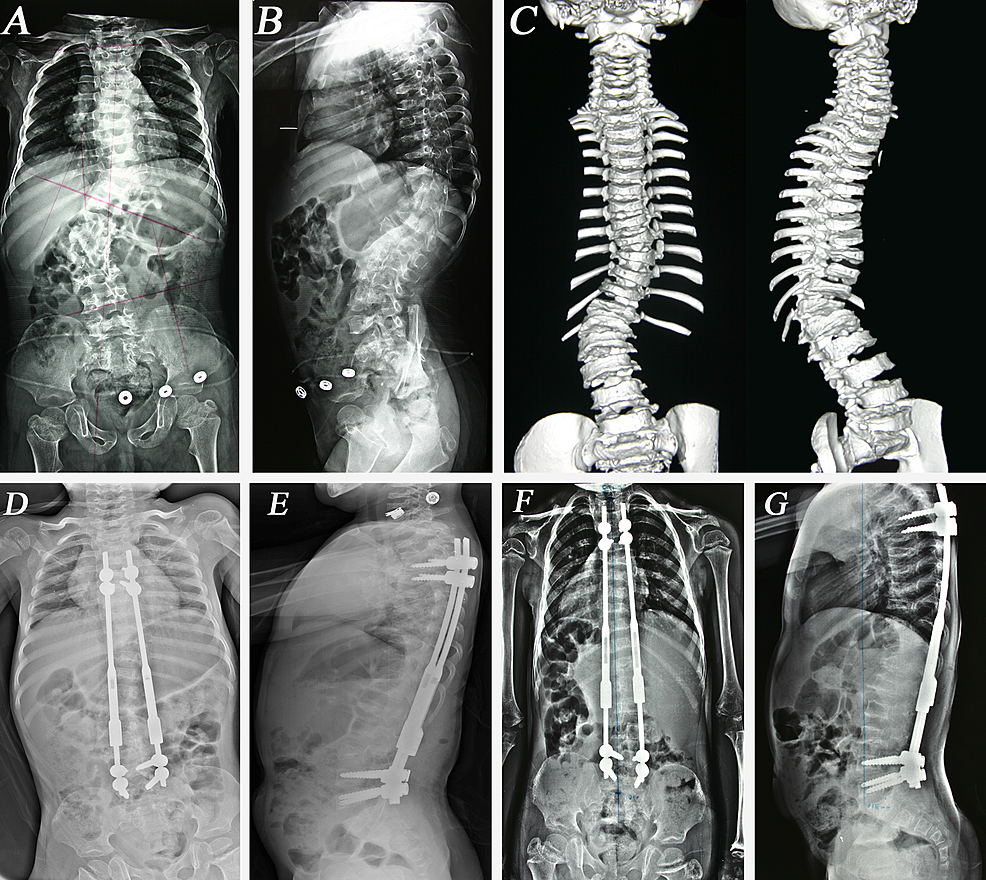 Cureus Traditional Dual Growing Rod Technique in the Management of