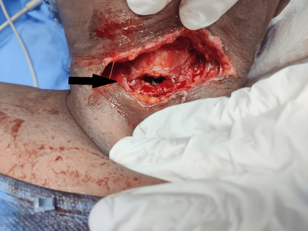 Clinical-photograph-demonstrating-the-anterior-neck-laceration-(black-arrow),-with-surrounding-soft-tissue-injury-at-presentation. Clinical-photograph-demonstrating-the-anterior-neck-laceration-(black-arrow),-with-surrounding-soft-tissue-injury-at-presentation.