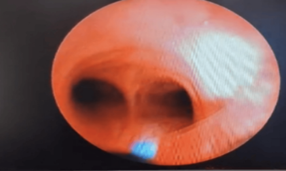 Intraoperative-flexible-fiberoptic-bronchoscopy-image-confirming-an-intact-airway,-with-no-mucosal-injury-visualized-to-the-level-of-the-carina-following-endotracheal-tube-placement-distal-to-the-laryngeal-defect. Intraoperative-flexible-fiberoptic-bronchoscopy-image-confirming-an-intact-airway,-with-no-mucosal-injury-visualized-to-the-level-of-the-carina-following-endotracheal-tube-placement-distal-to-the-laryngeal-defect.