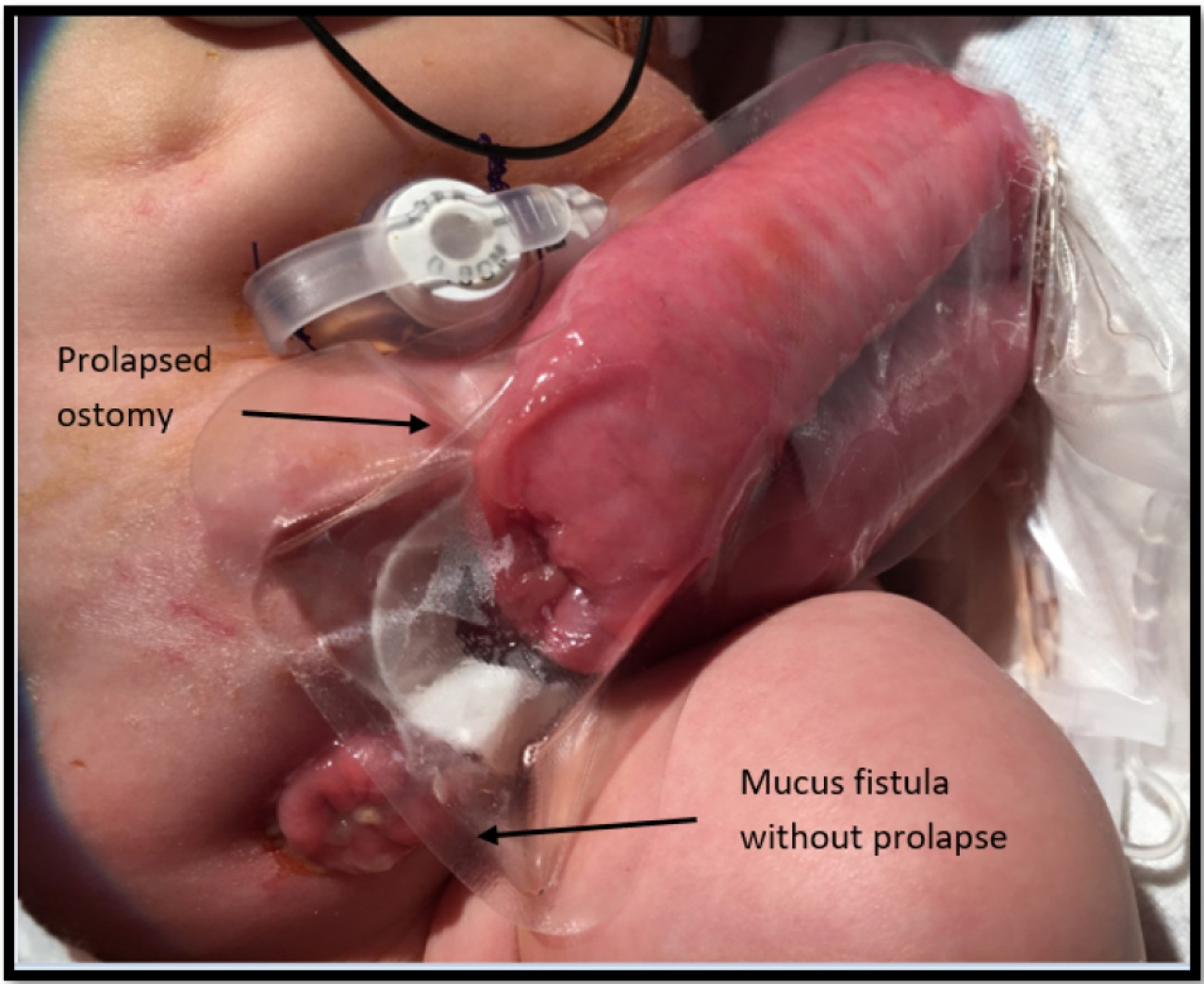 mucous fistula