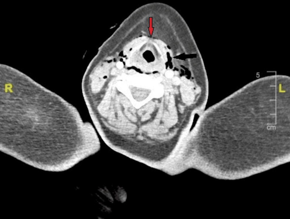 Axial-contrast-enhanced-CT-scan-of-the-neck-demonstrating-extensive-subcutaneous-and-deep-cervical-emphysema-(black-arrow)-with-anterior-laryngeal-wall-disruption-at-the-level-of-the-thyroid-cartilage-(red-arrow). Axial-contrast-enhanced-CT-scan-of-the-neck-demonstrating-extensive-subcutaneous-and-deep-cervical-emphysema-(black-arrow)-with-anterior-laryngeal-wall-disruption-at-the-level-of-the-thyroid-cartilage-(red-arrow).