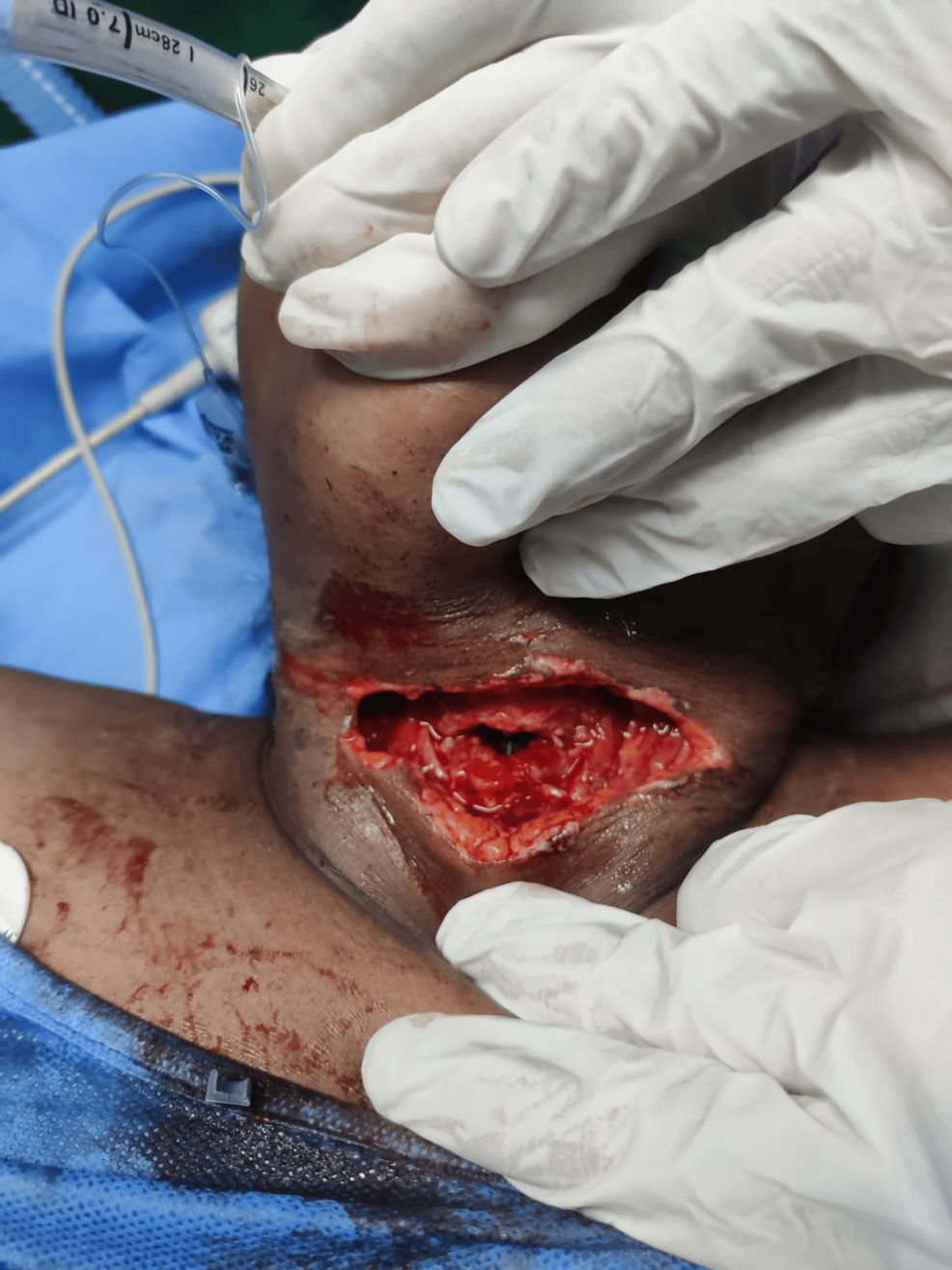 Intraoperative-clinical-image-demonstrating-orotracheal-intubation-in-a-patient-with-a-self-inflicted-penetrating-laryngotracheal-injury. Intraoperative-clinical-image-demonstrating-orotracheal-intubation-in-a-patient-with-a-self-inflicted-penetrating-laryngotracheal-injury.