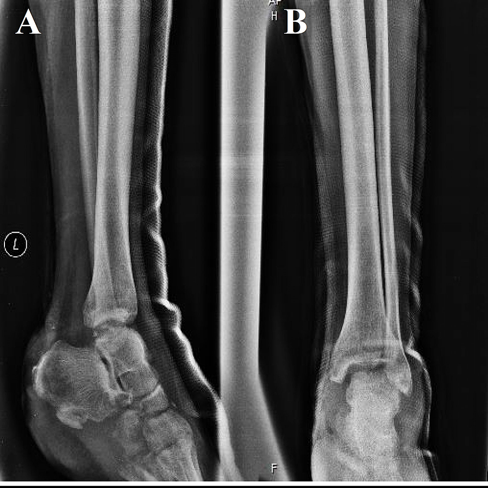 Cureus Management of Heel Pad Degloving Injury After Severe Foot