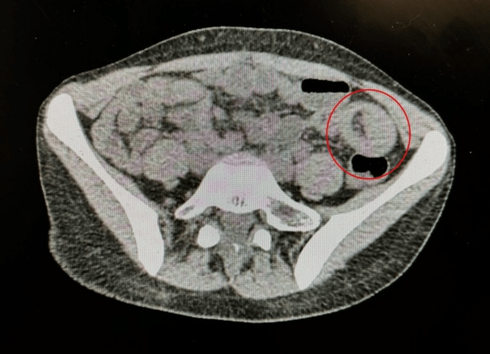 Jejunal Adenomatous Polyp Presenting as Intussusception in Peutz-Jeghers Syndrome: A Unique Case with VHL Mutation Carrier Status - News Directory 3