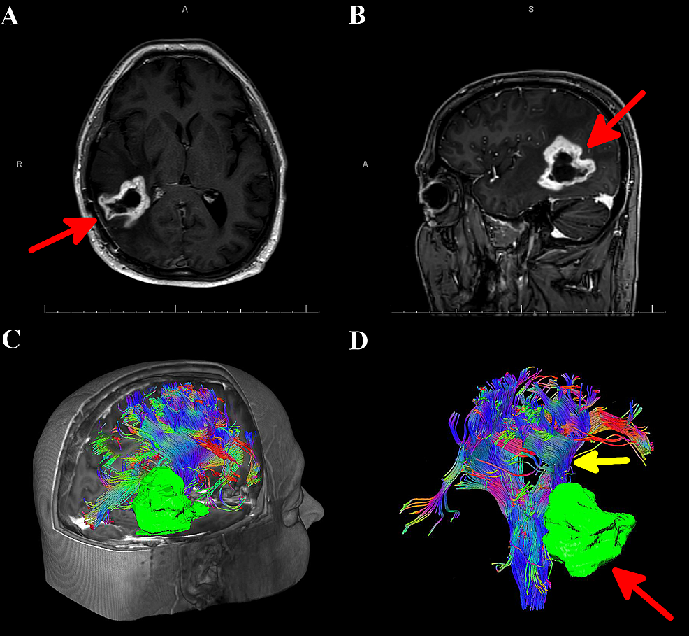 MRI-of-the-brain-and-automated-whole-brain-tractography(AWBT)-for-Case-2