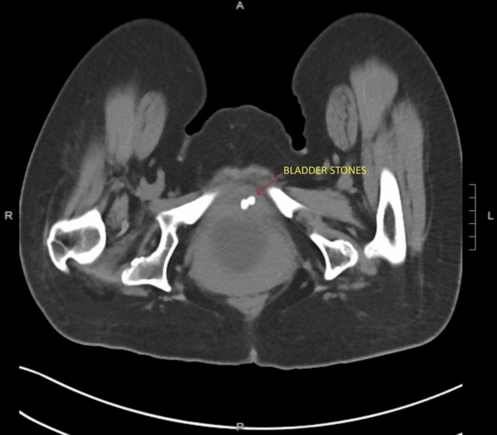 Cross-sectional-image-of-the-patient's-preoperative-CT-scan-showing-two-large,-non-obstructing-bladder-stones. Cross-sectional-image-of-the-patient's-preoperative-CT-scan-showing-two-large,-non-obstructing-bladder-stones.