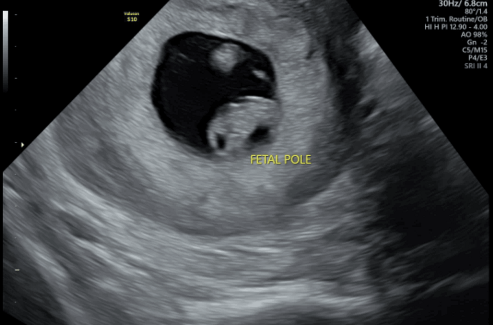 First-trimester-transvaginal-ultrasound-showing-singleton-fetal-pole. First-trimester-transvaginal-ultrasound-showing-singleton-fetal-pole.