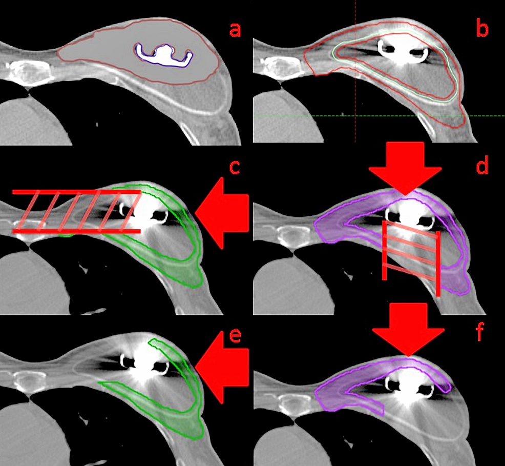 Cureus FieldSpecific Intensitymodulated Proton Therapy Optimization Technique for Breast