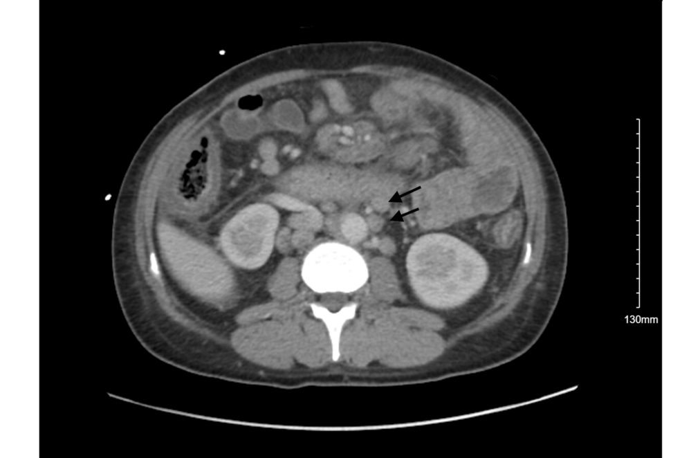 Disseminated Histoplasmosis in a Patient With Acquired Immunodeficiency Syndrome: A Case Report and Literature Review