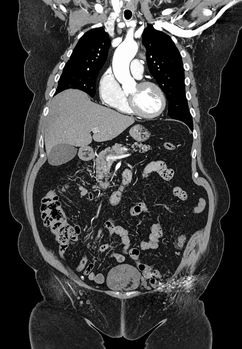 Terminal Ileum Diffuse Large B-cell Lymphoma Presenting as Bowel Perforation