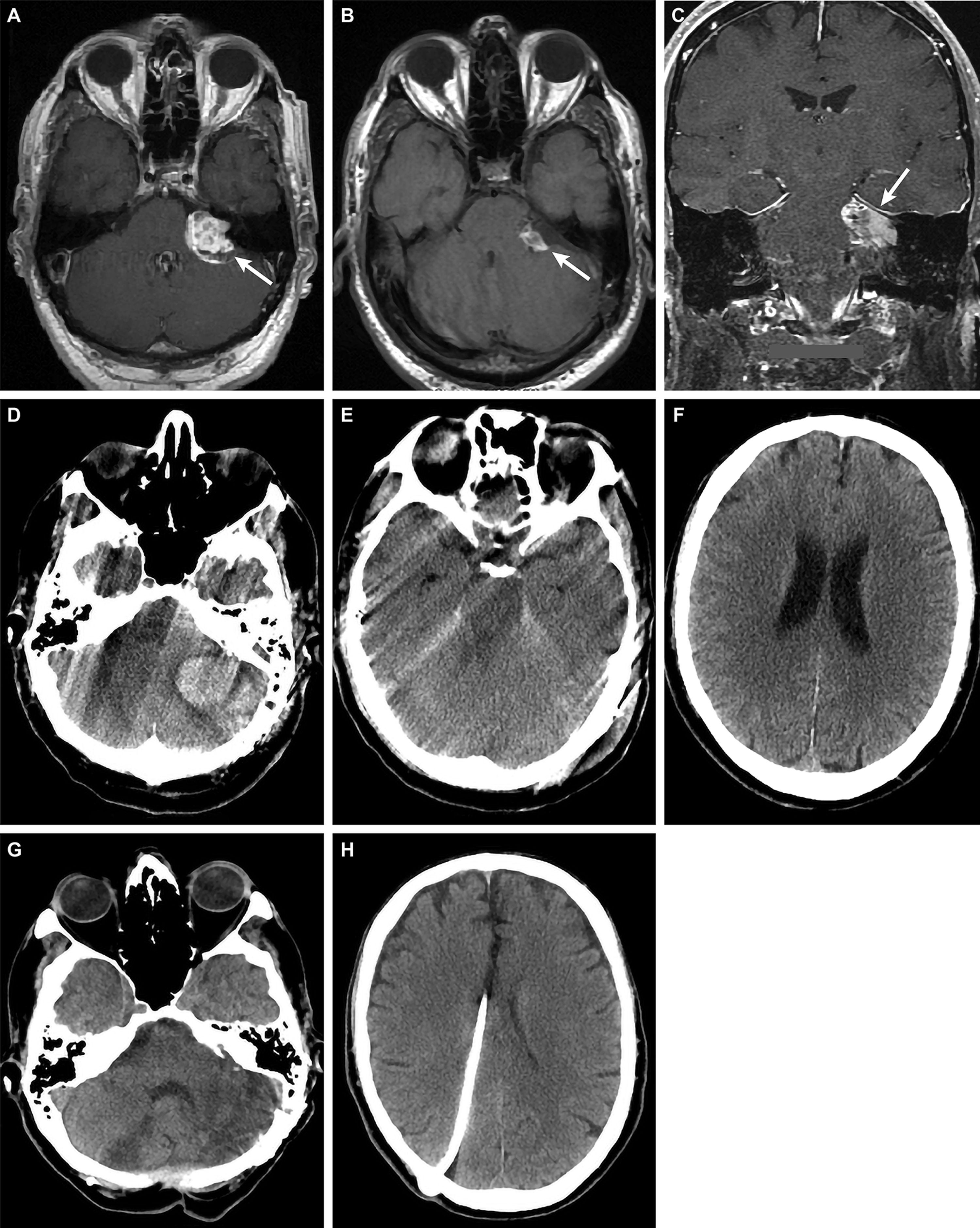 Cureus Posterior Fossa Hemorrhage Following The Use Of Low Molecular Weight Heparin Lessons Learned And Recommendations For The Treatment And Prophylaxis Of Postoperative Venous Thromboembolism