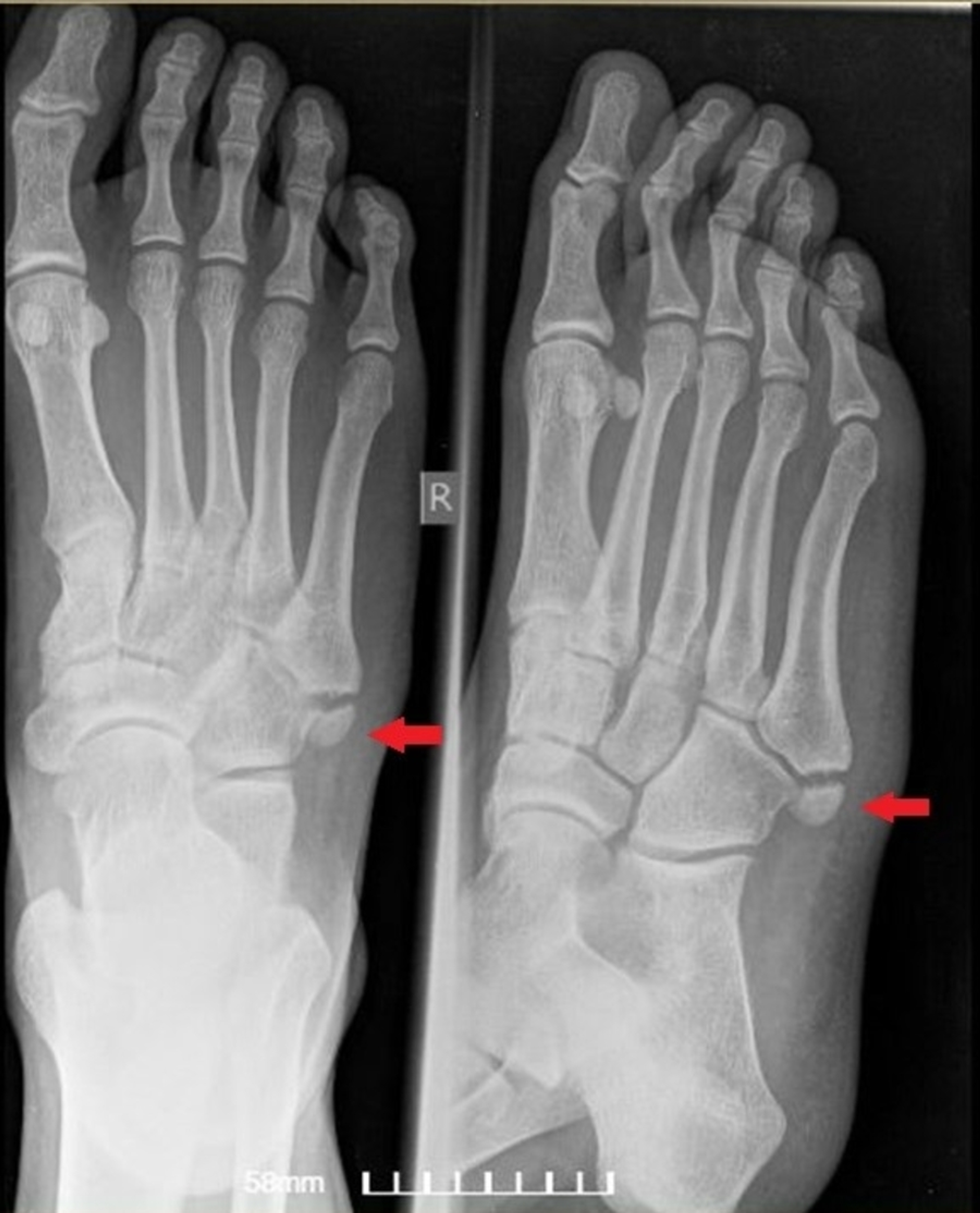 Cureus | Os Vesalianum Pedis in a Young Adult: A Case Report and ...