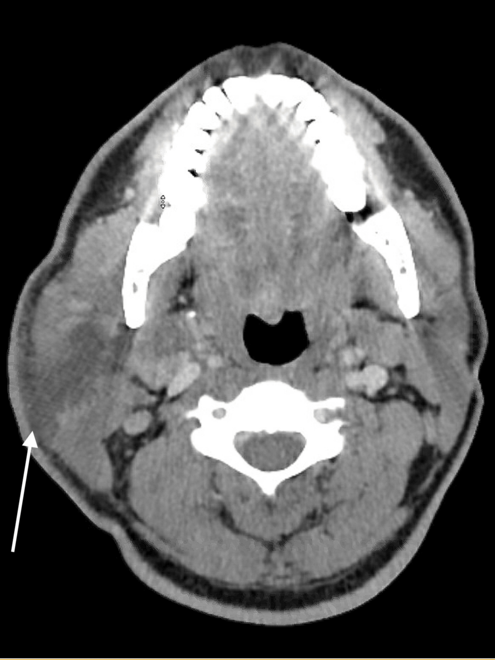 Brucella Melitensis Parotid Abscess Associated With Warthin's Tumour: A Case Report