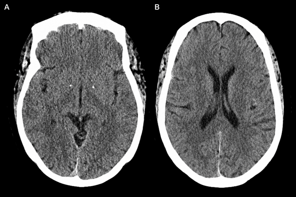 Possible Interaction Between Hibiscus and Warfarin Resulting in Severe International Normalized Ratio Elevation: A Case Report