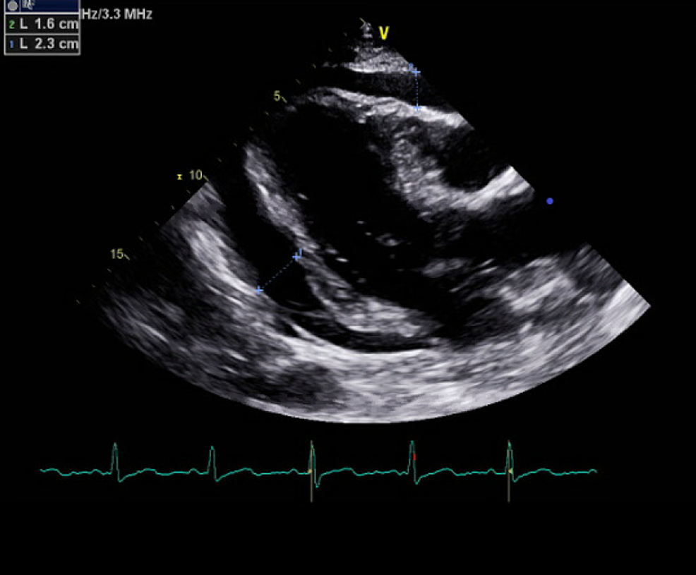 cureus-relapsing-multiple-myeloma-presenting-as-cardiac-tamponade-and