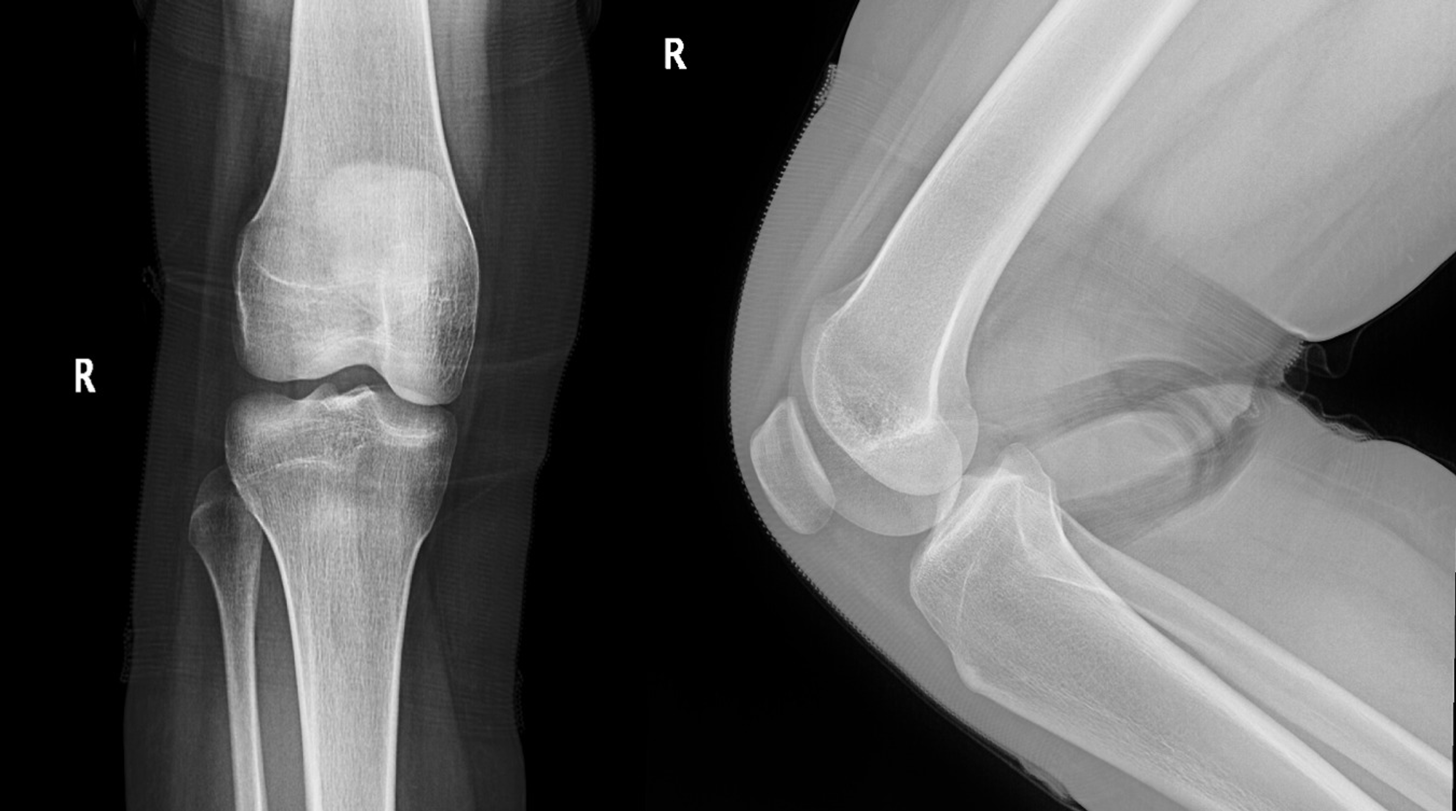 Cureus | Giant Cell Tumor Of Tendon Sheath In Knee Capsule