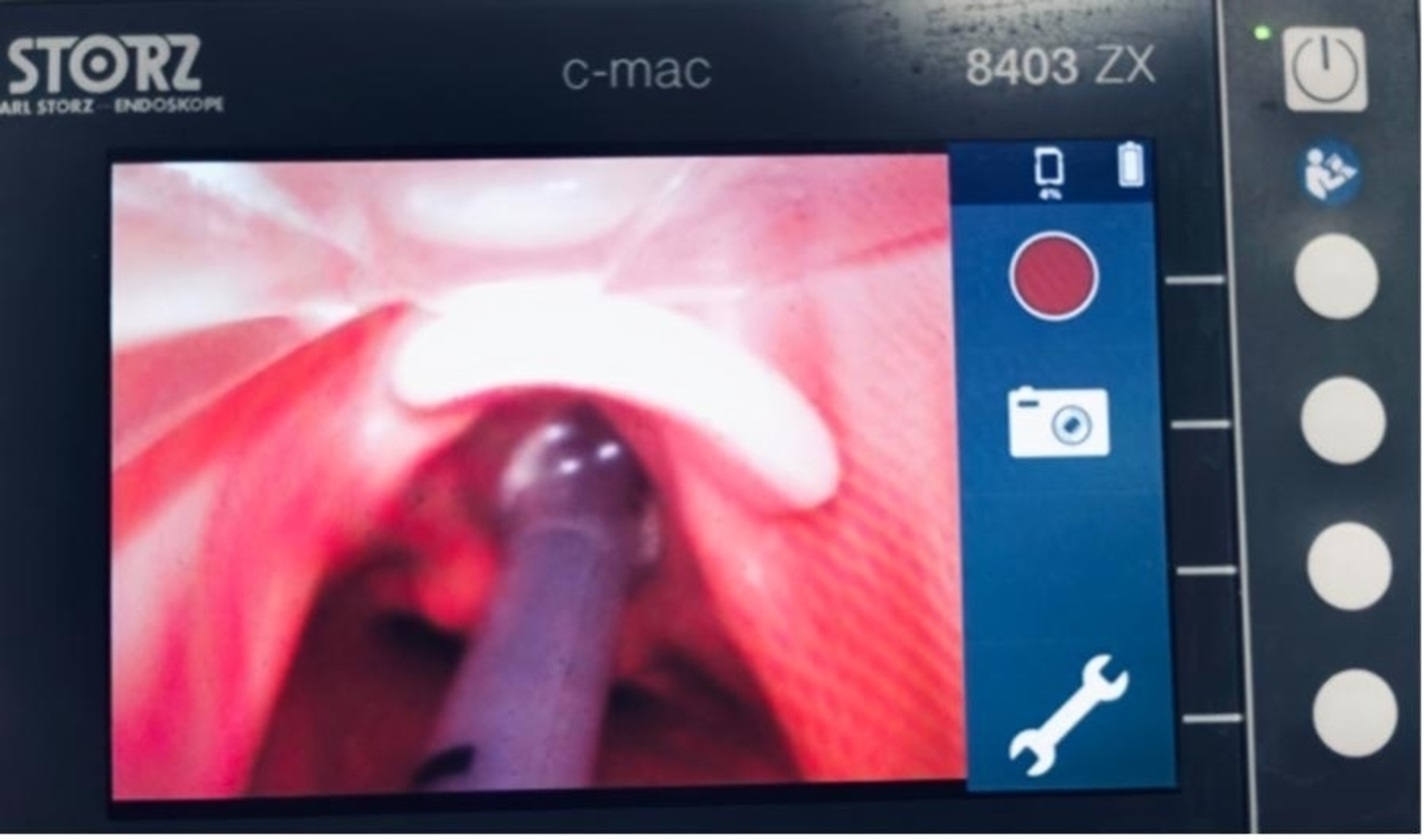 Cureus A Safe Approach to Percutaneous Tracheostomy for COVID19