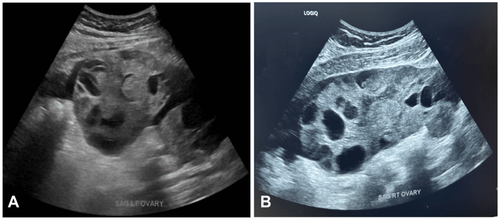 Ovarian Hyperstimulation Syndrome: A Rare Cause of Abdominal Pain in the Emergency Department