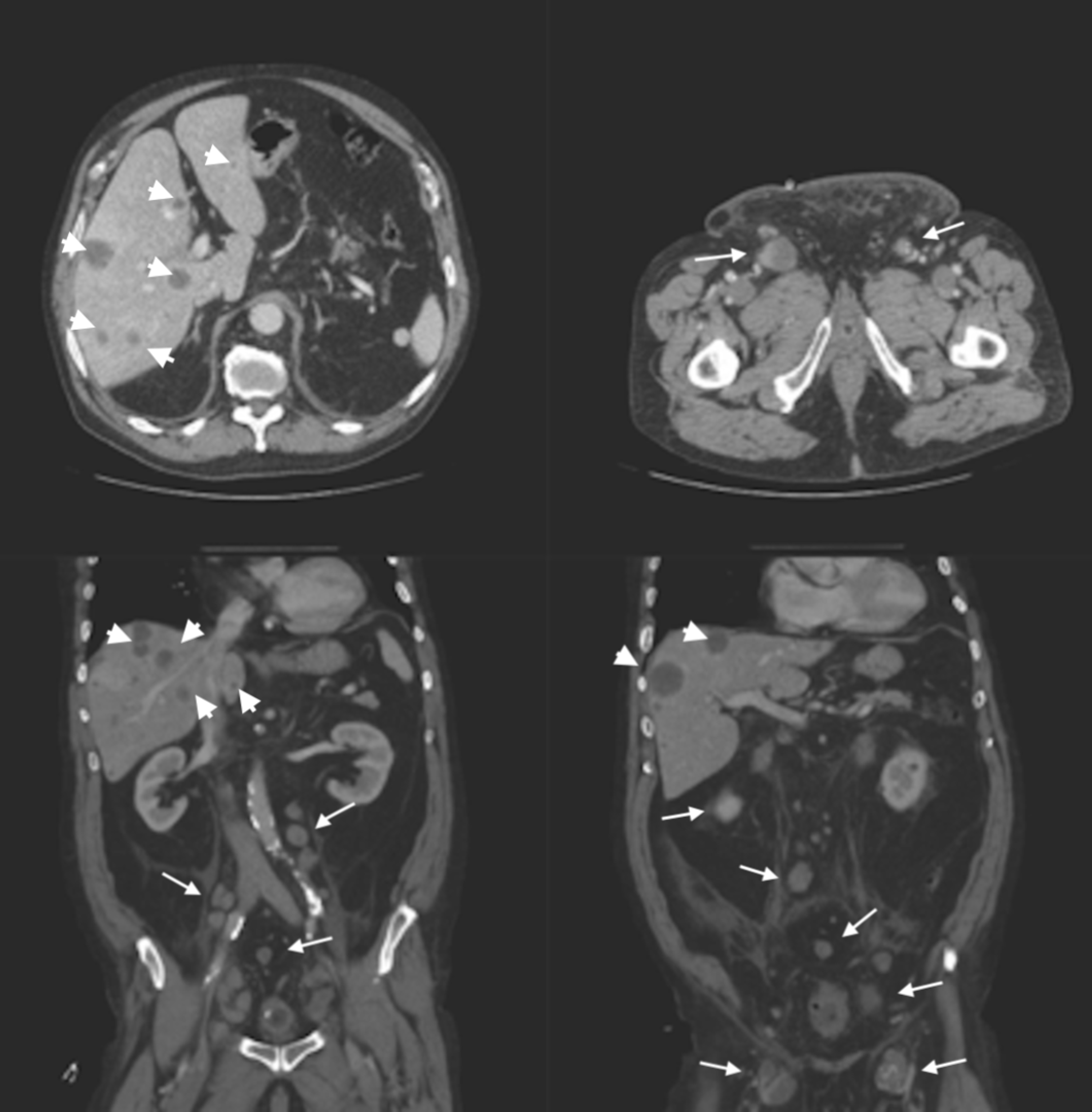Cureus Perianal Paget Disease Different Entities With The Same Name