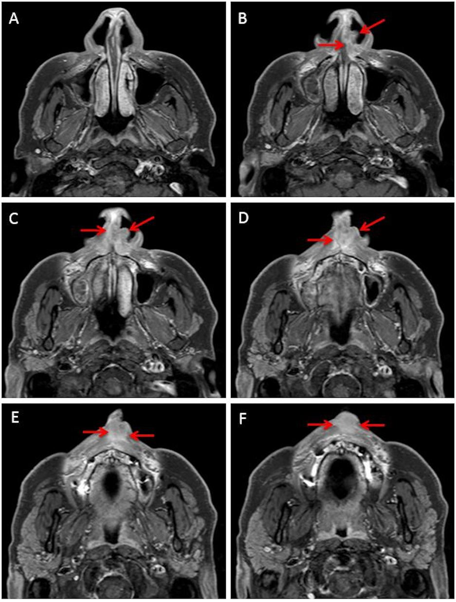 Download Cureus Combination Intensity Modulated Proton Therapy And Passive Scatter Boost For Rapidly Progressing Nasal Cavity Squamous Cell Carcinoma PSD Mockup Templates