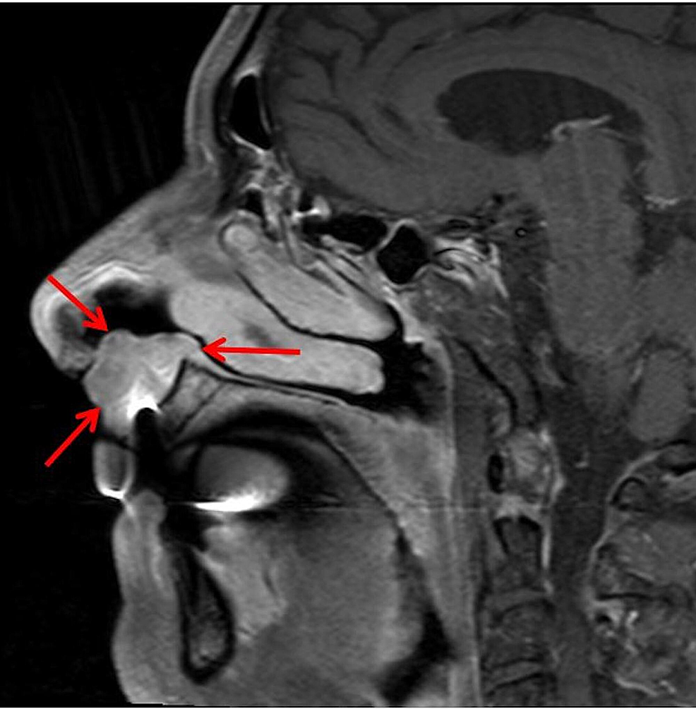 Download Cureus Combination Intensity Modulated Proton Therapy And Passive Scatter Boost For Rapidly Progressing Nasal Cavity Squamous Cell Carcinoma PSD Mockup Templates