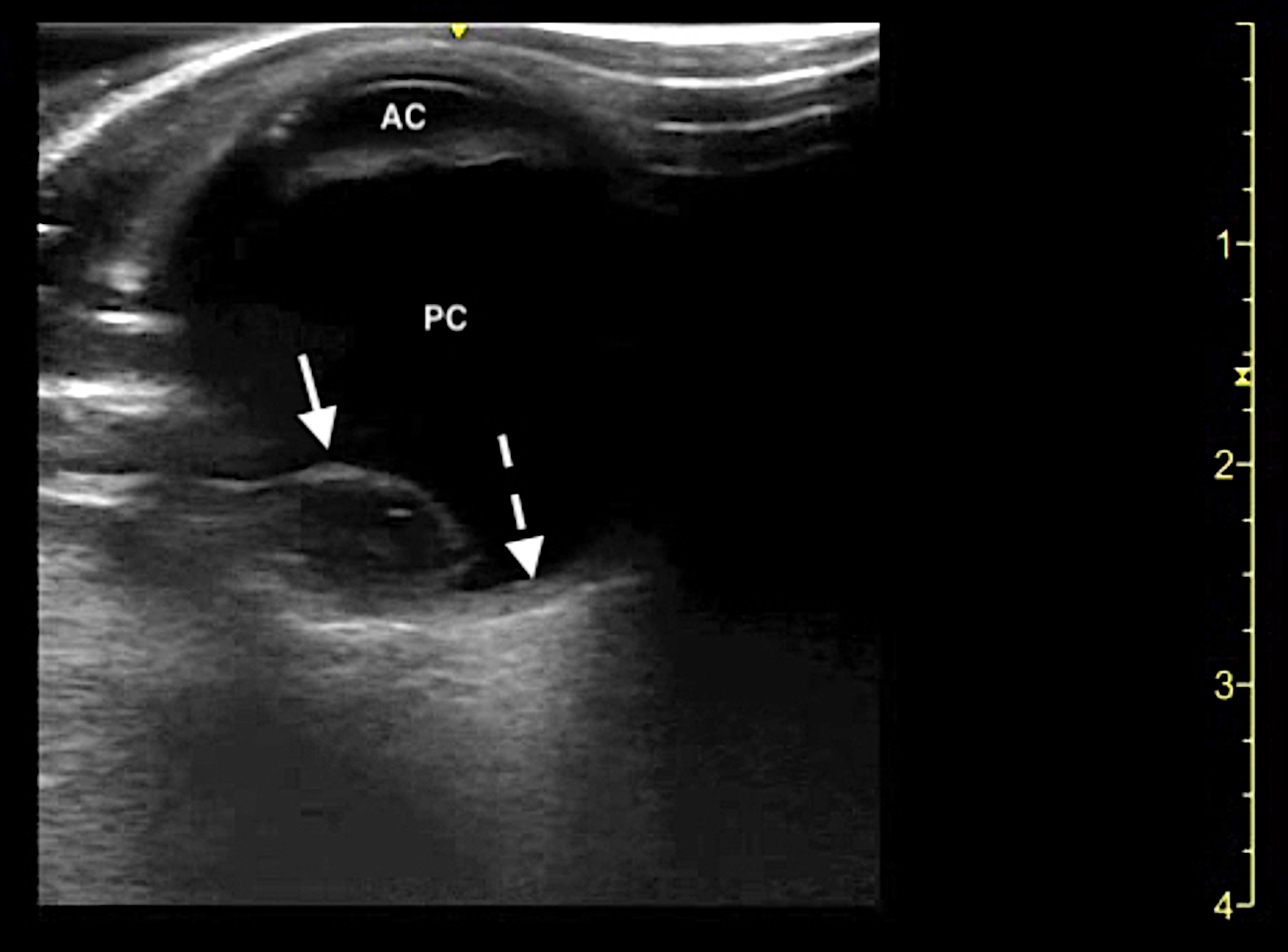 Cureus Bedside Ocular Ultrasound Diagnosis of a Traumatic Lens