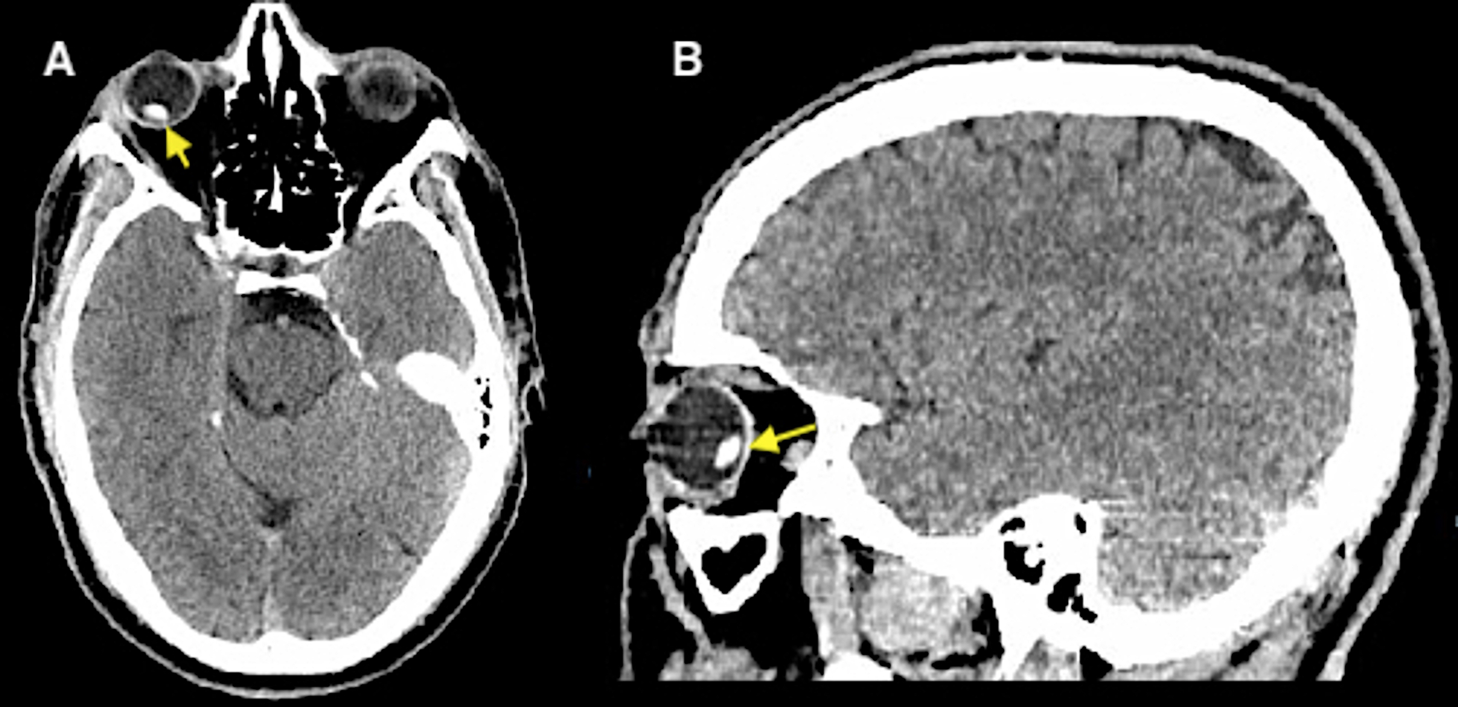 Cureus Bedside Ocular Ultrasound Diagnosis of a Traumatic Lens